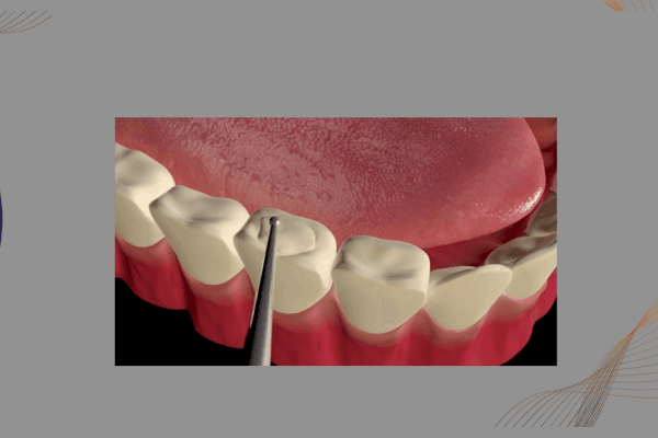 Endodoncia