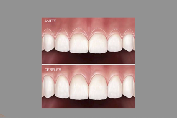 Periodoncia
