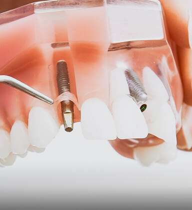 Duperly_implantologia_02